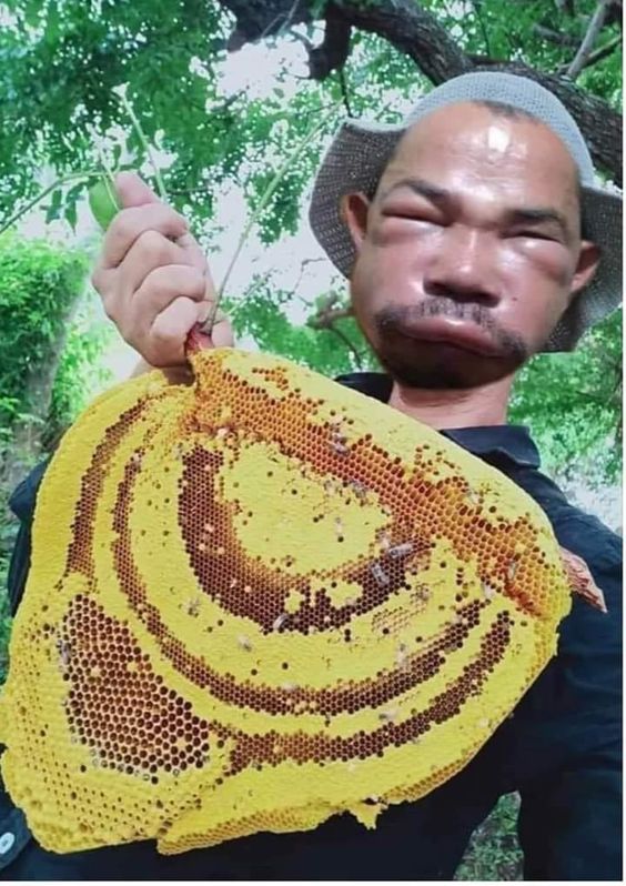 벌꿀 꿀벌 벌집 벌에 쏘인 얼굴